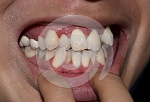 Stacked or overlapping white teeth. Also called crowded teeth