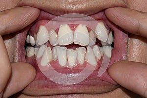 Stacked or overlapping white teeth. Also called crowded teeth