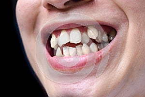 Stacked or overlapping white teeth. Also called crowded teeth