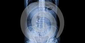 stag horns stone or renal calculi in right kidney.