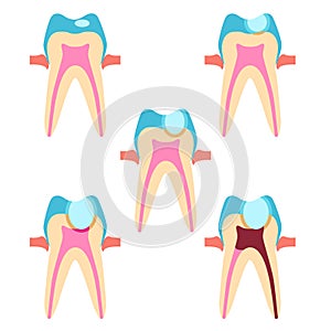 Stage of caries