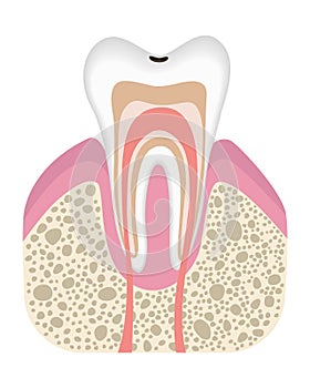 Stage of caries development. Tooth structure in flat style. Tooth decay with enamel. Dental disease realistic vector