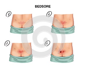 Stage of formation of bedsores