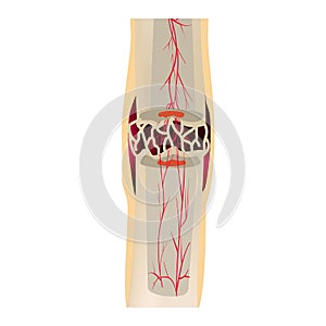 3 Stage Of Healing Bone Fracture. callus ossification. The bone fracture. Infographics. Vector illustration on isolated