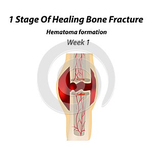 1 Stage Of Healing Bone Fracture. Formation of callus. The bone fracture. Infographics. Vector illustration on isolated photo