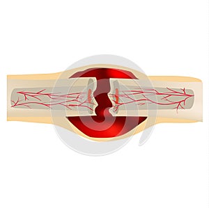 1 Stage Of Healing Bone Fracture. Formation of callus. Hematoma. The bone fracture. Infographics. Vector illustration on