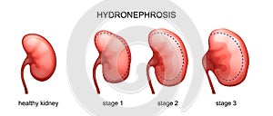 The stage of hydronephrosis