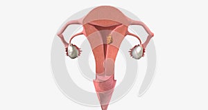 Stage I endometrial cancer begins in the endometrium and spreads to the myometrium of the uterus