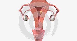 Stage I endometrial cancer begins in the endometrium and spreads to the myometrium of the uterus