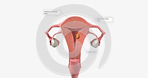 Stage I endometrial cancer begins in the endometrium and spreads to the myometrium of the uterus photo