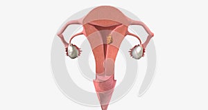 Stage I endometrial cancer begins in the endometrium and spreads to the myometrium of the uterus photo