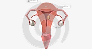 Stage I endometrial cancer begins in the endometrium and spreads to the myometrium of the uterus photo