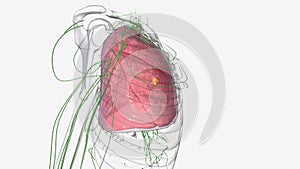 A stage I lung cancer is a small tumor that has not spread to any lymph nodes