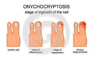 Stage of ingrowth of the nail photo