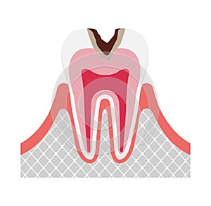 The stage of tooth decay illustration / Decay in dentin photo