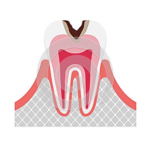 The stage of tooth decay illustration / Decay in dentin