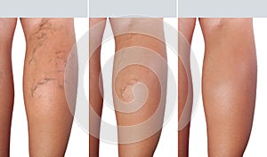 Stage treatment of enlarged veins from extended veins to healthy veins