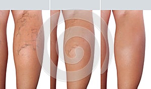 Stage treatment of enlarged veins from extended veins to healthy veins photo