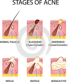 Stages of acne formation in the human skin