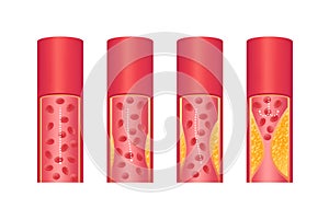 Stages of atherosclerosis. Atherosclerosis formation Healthy artery and unhealthy arteries.
