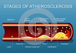 Stages of atherosclerosis. Close-up of an Arterial wall