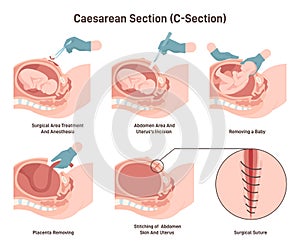 Stages of baby birth with caesarean section. Fetus position during photo