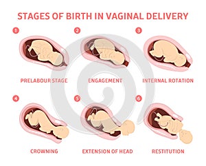 Stages of baby birth in vaginal delivery