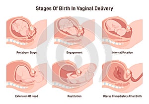 Stages of baby birth in vaginal delivery. Fetus movement during the labor.