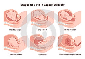 Stages of baby birth in vaginal delivery. Fetus movement during the labor. photo