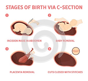 Stages of baby birth via cesarean section