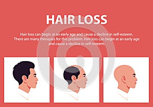 The stages of baldness. Alopecia. Profiles of Asian men.
