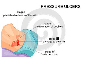 Stages of bedsores photo