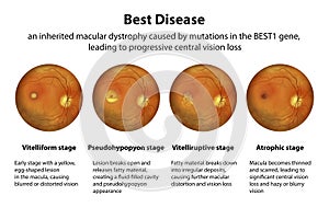 Stages of Best vitelliform macular dystrophy, illustration