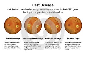 Stages of Best vitelliform macular dystrophy, illustration photo