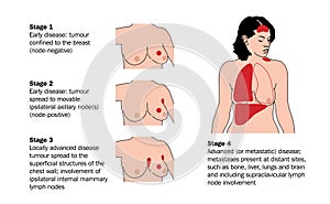 Progreso de senos cáncer 