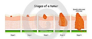 Stages of cancer. Classification of Malignant Tumours