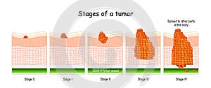 Stages of cancer. Classification of Malignant Tumours photo