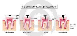 Stages of caries development.