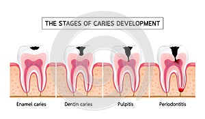 Stages of caries development.