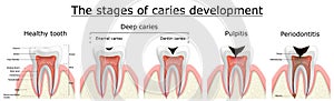 Stages of caries development. Dental disease: caries, pulpitis and periodontitis, realistic vector illustration