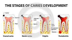Průběh z zubní kaz rozvoj 