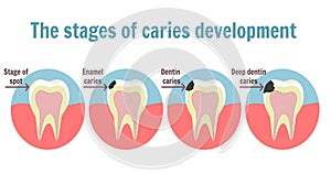 The stages of caries development. Dental toothache symbol photo