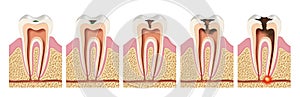 Stages of caries development Periodontitis photo