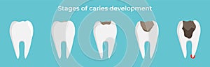 Stages of caries development, tooth dekay, dental concept, vector illustration on blue background.