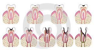 Stages of caries development. Tooth structure in flat style. Tooth decay with enamel. Dental disease caries, pulpitis