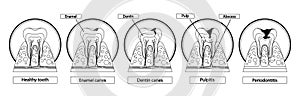 Stages Of Caries Infographic. Healthy Tooth, Enamel Caries, Dentin Caries, Pulpitis and Periodontitis Cross Section View
