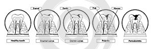 Stages Of Caries Infographic. Healthy Tooth, Enamel Caries, Dentin Caries, Pulpitis and Periodontitis Cross Section View photo