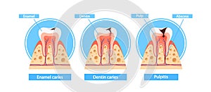 Stages Of Caries Infographics. Enamel Caries, Dentin Caries, And Pulpitis Cross Section View. Medical Visual Information