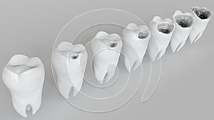 The stages of caries on the molar - 3D Rendering