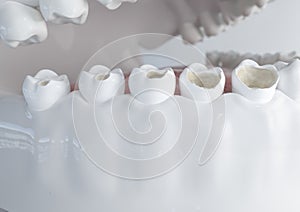 The stages of caries on the molar - 3D Rendering